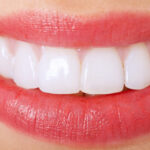 Good News About Porcelain Veneers