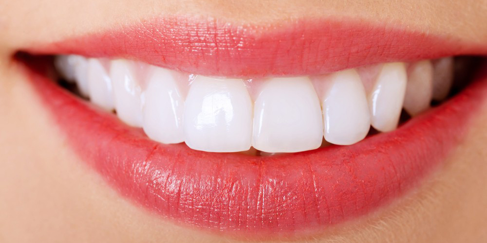 Good News About Porcelain Veneers