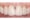 Dental Bridge - After
