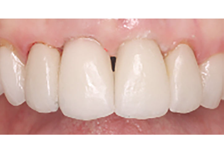 Dental Bridge - After