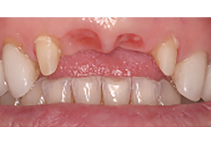 Dental Bridge - Before