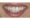 Tooth Repair - After