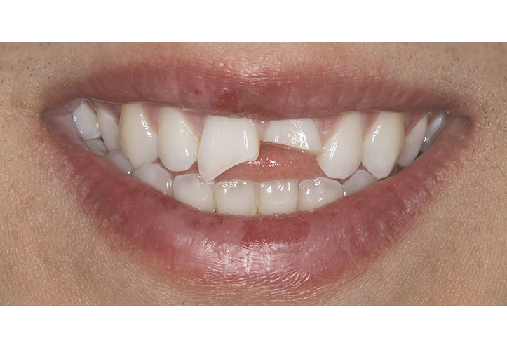 Tooth Repair - Before