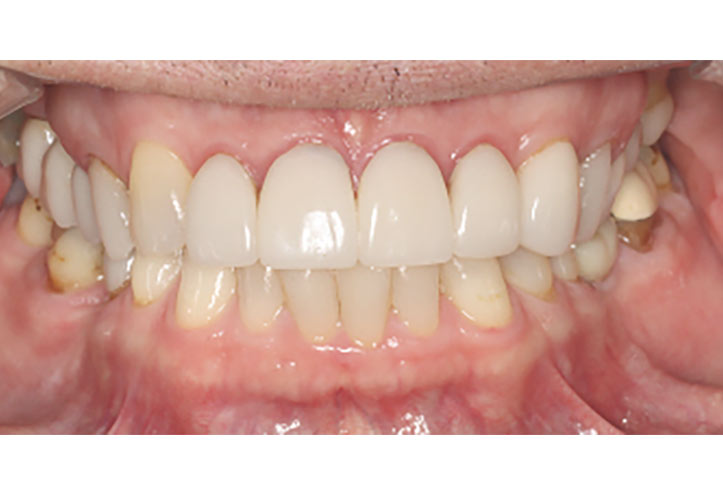 Teeth Whitening - Before