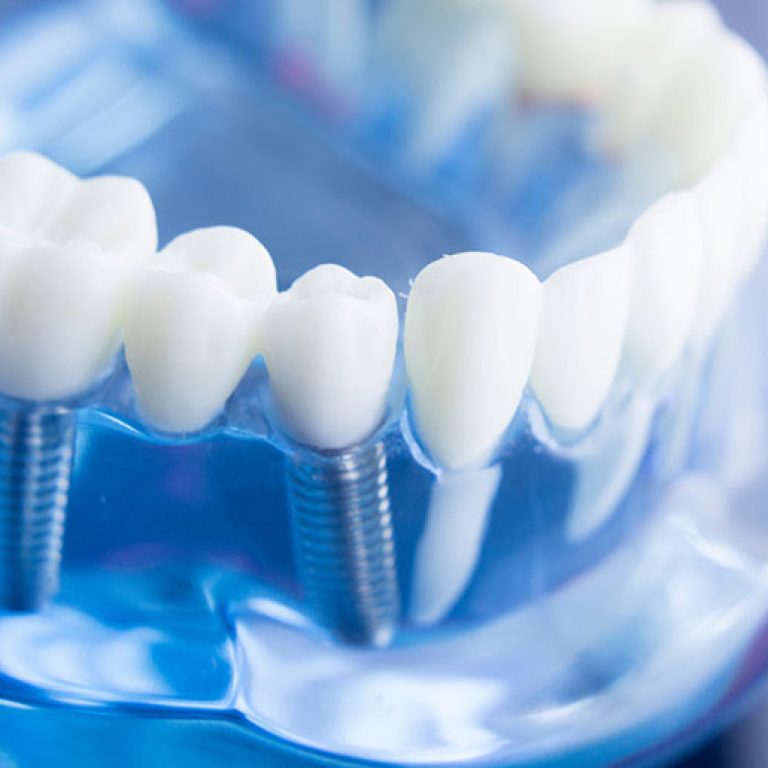 Dental tooth dentistry student learning teaching model showing teeth, roots, gums, gum disease, tooth decay and plaque.