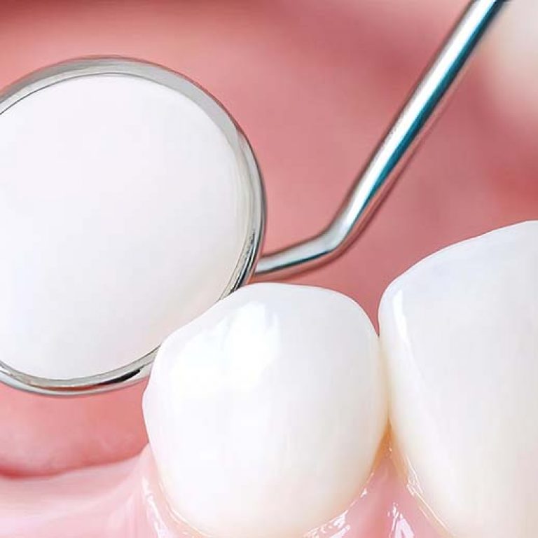 Close-up of filling being polished, tooth detail, clean dental procedure