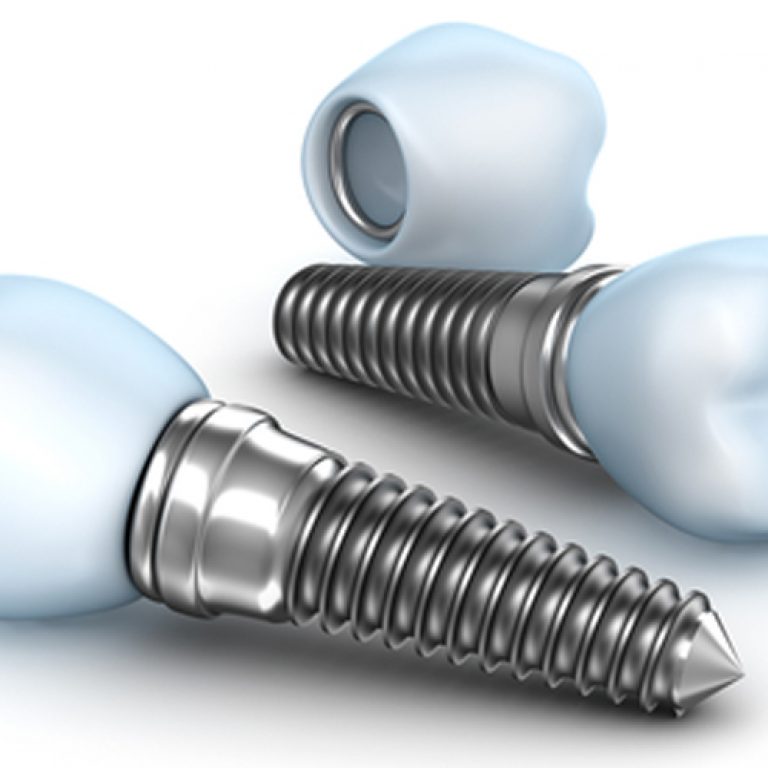dental-implants-1-1