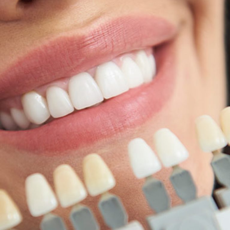 f-Teeth-Whitening-01