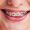 f-Traditional-Braces-01