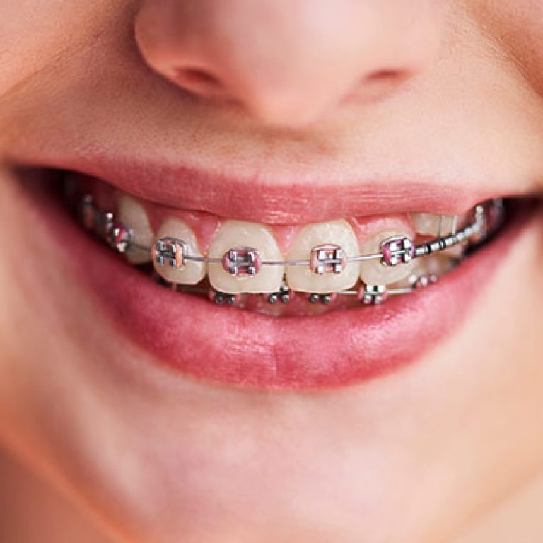 f-Traditional-Braces-01