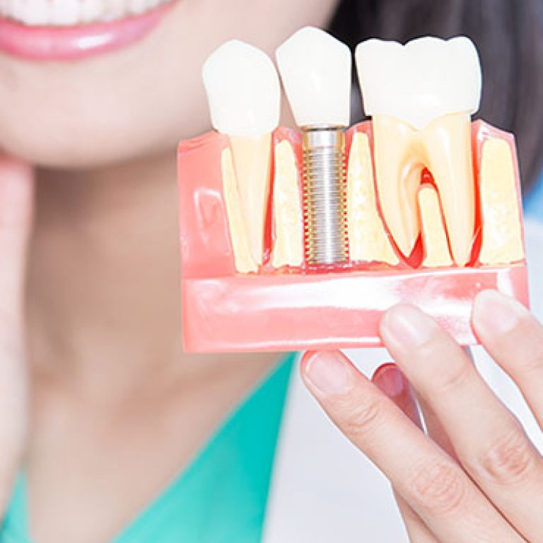 woman dentist take implant tooth and touch tooth on the blue background