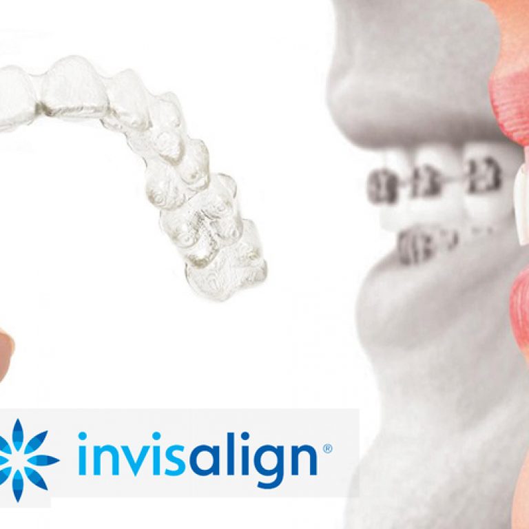 invisalign