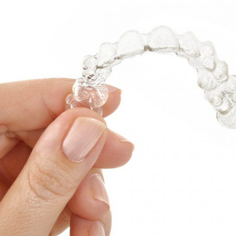invisalign1-1-1000x520