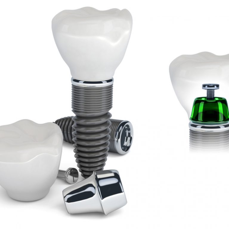 parts-of-dental-implant-1