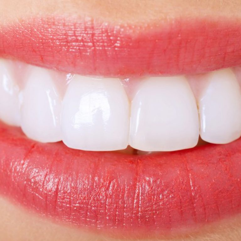 Good News About Porcelain Veneers