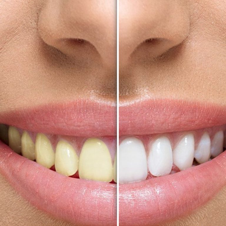 teeth_whitening