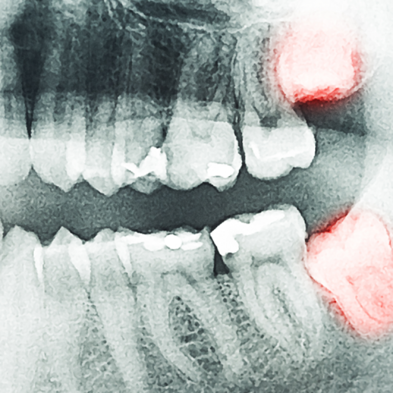 wisdom_teeth